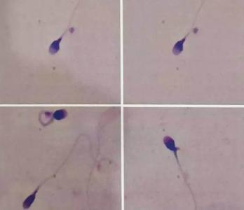 如何远离精囊腺炎?